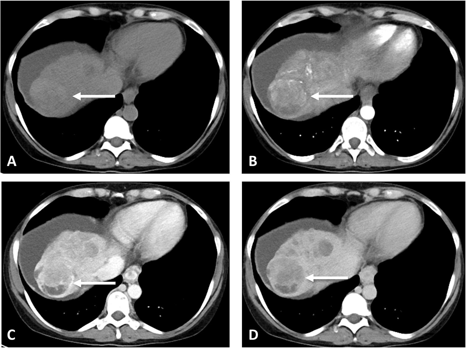 hepatocellular-carcinoma-state-of-the-art-imaging-and-recent-advances