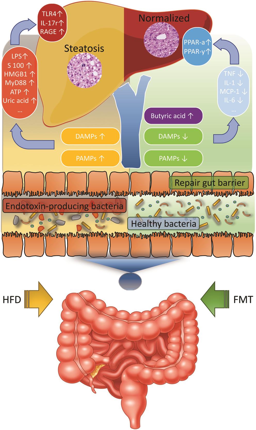 Fecal Microbiota Transplantation For The Treatment Of Nonalcoholic ...